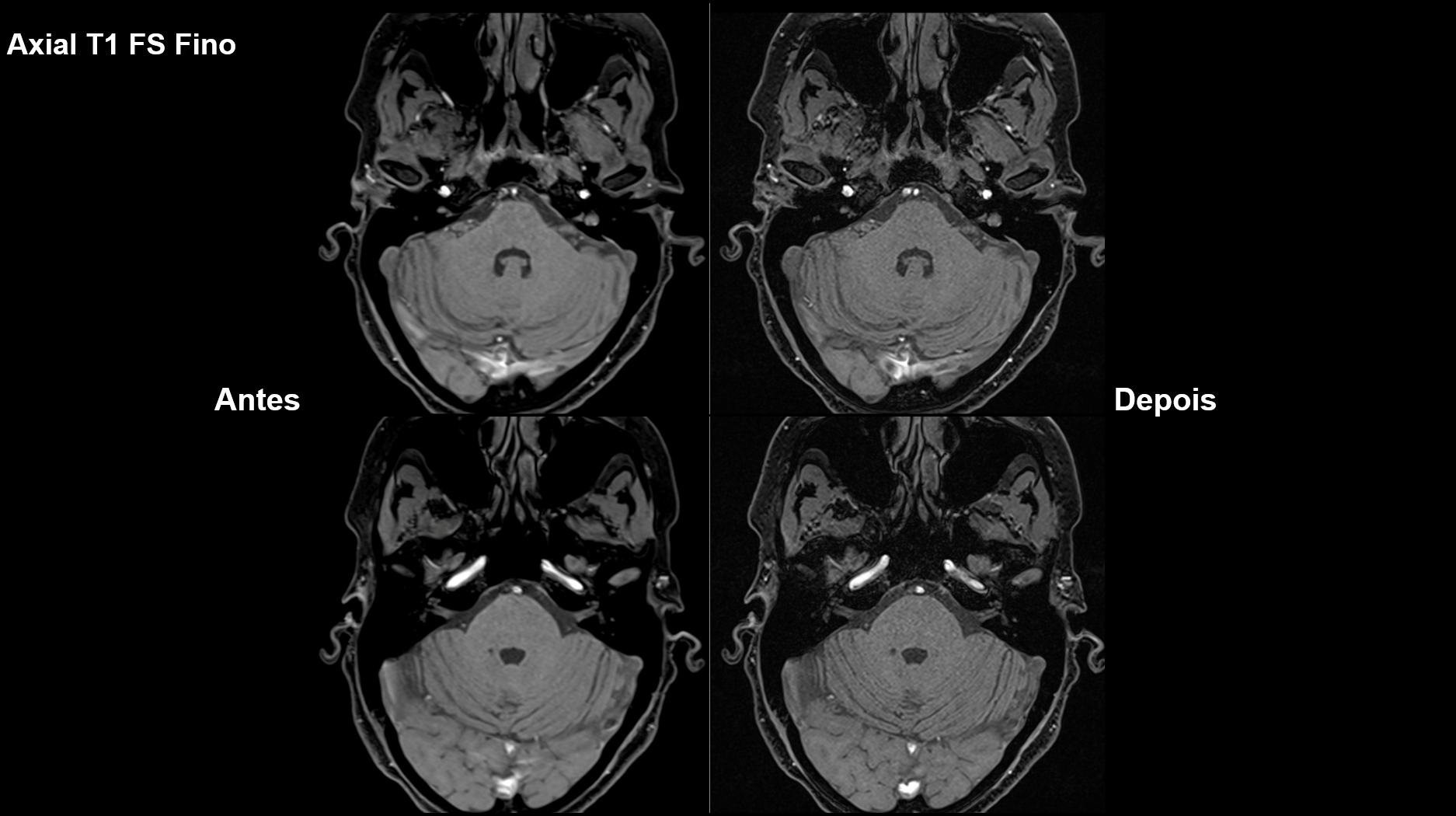 Melhorando a Efici&ecirc;ncia e a Qualidade dos Exames de Resson&acirc;ncia Magn&eacute;tica: Um Caso de Sucesso com a Unimed Chapec&oacute; e MRIONLINE
