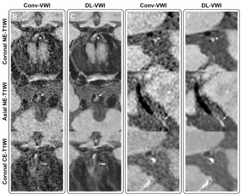 Como melhorar a detecção de lesões na ressonância magnética de parede vascular? Como melhorar a detecção de lesões na ressonância magnética de parede vascular?