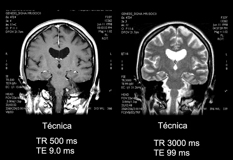 Par&acirc;metros TR e TE: o que s&atilde;o e o que fazem na RM