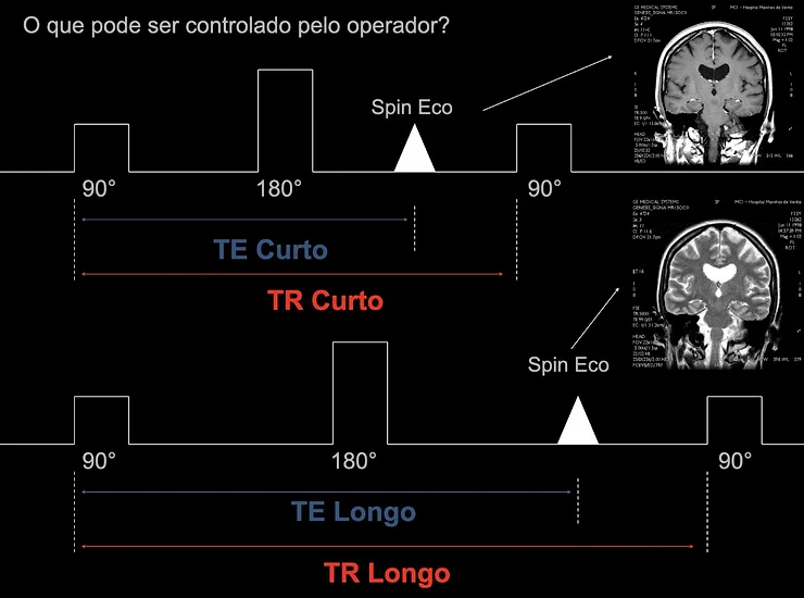 Par&acirc;metros TR e TE: o que s&atilde;o e o que fazem na RM