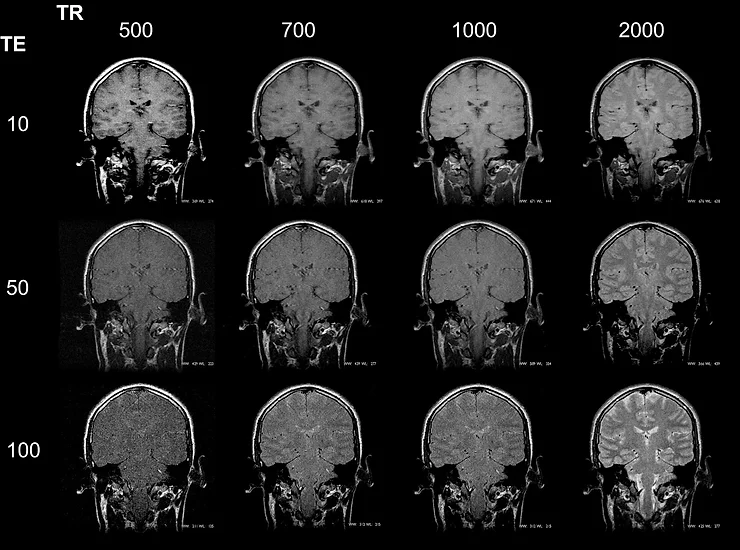 Par&acirc;metros TR e TE: o que s&atilde;o e o que fazem na RM