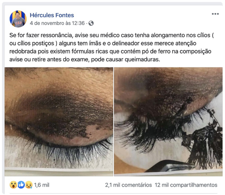 Fake News sobre Cílios Postiços, Queimaduras e Ressonância Magnética - Nota de Esclarecimento do MRI Fake News sobre Cílios Postiços, Queimaduras e Ressonância Magnética - Nota de Esclarecimento do MRI