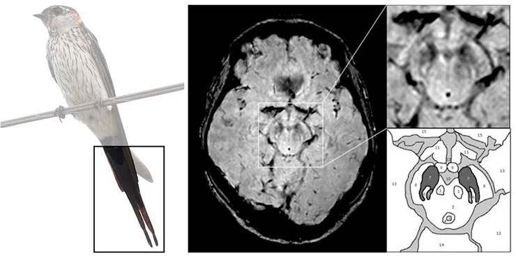 A Cauda da Andorinha: RM e o diagn&oacute;stico de Parkinson